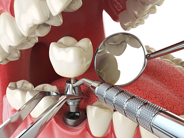 Best Emergency Wisdom Tooth Extraction in Dallas, NC